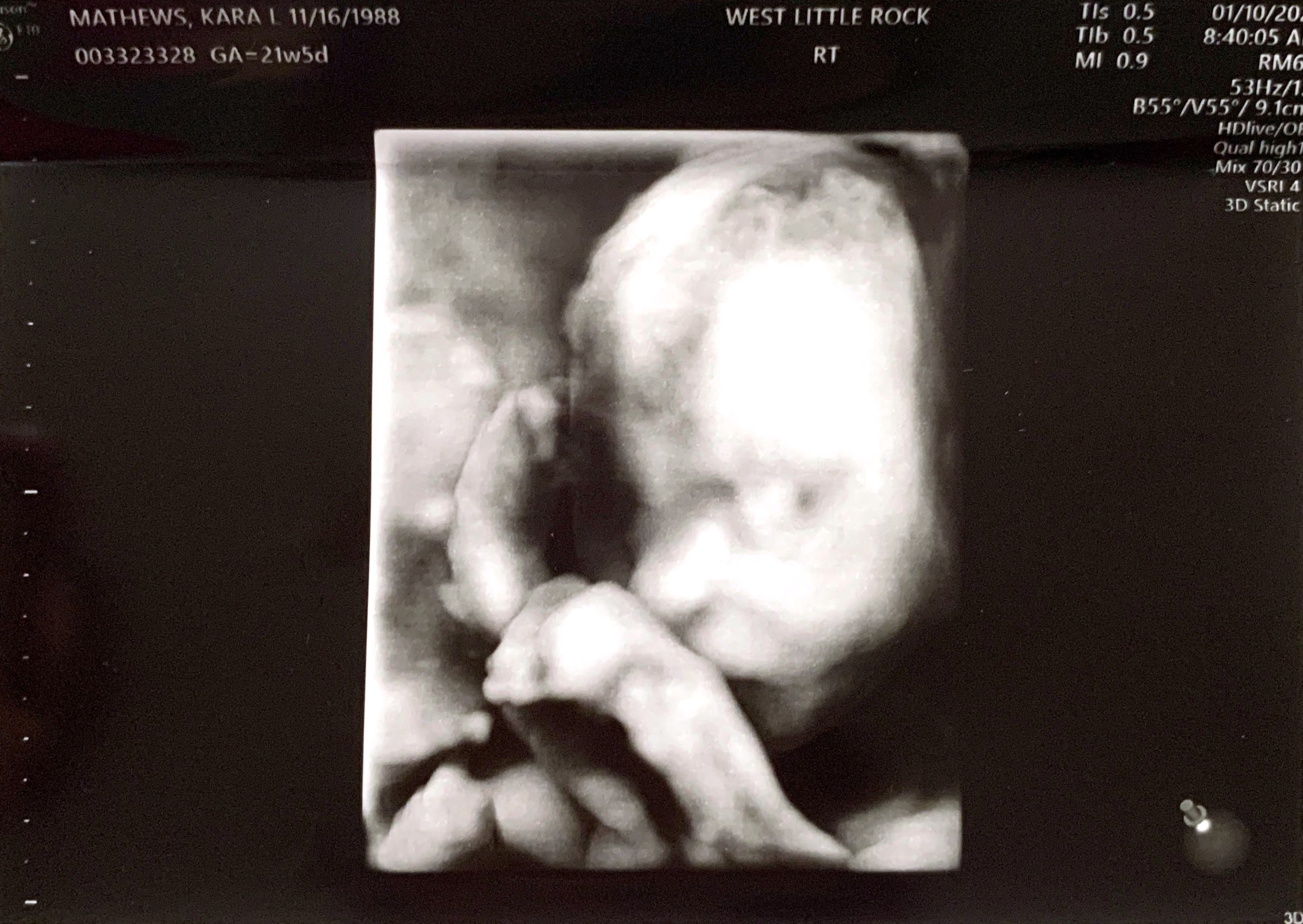 Baby ultrasound-2